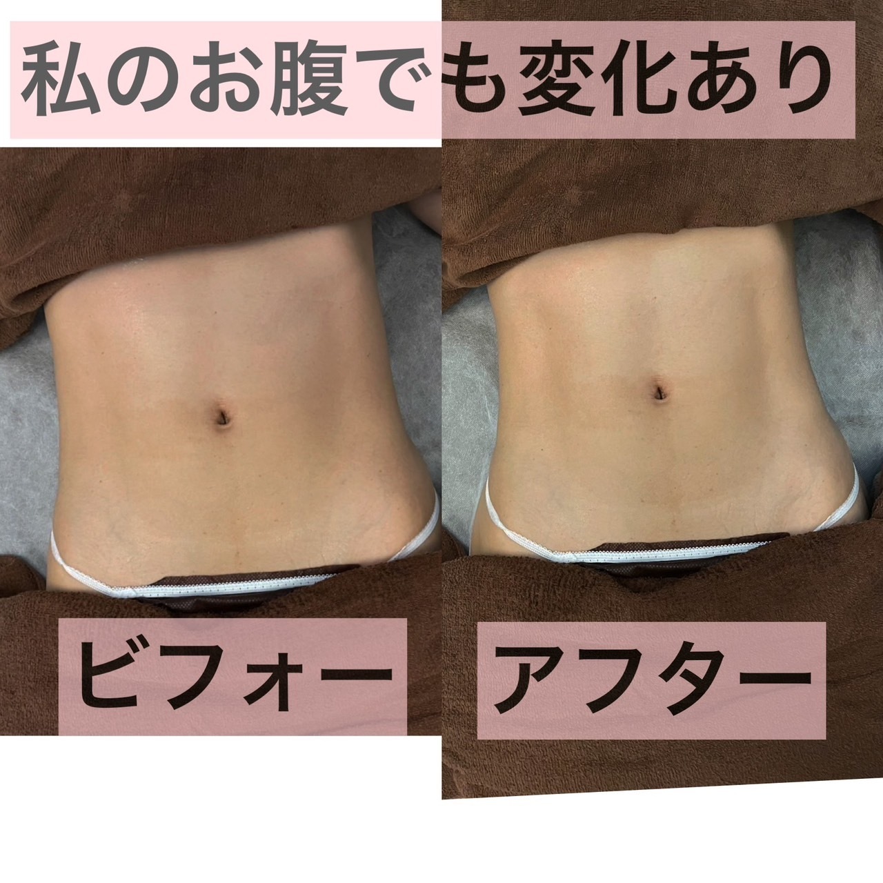 キャビテーション