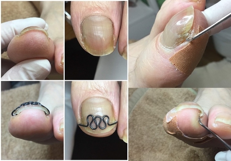 斜めに切っていた爪をよく見ると Coubic