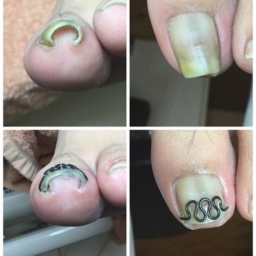 膿んだこともあった巻き爪 Coubic