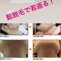 ☆男性限定☆どんな濃いヒゲもつるつるに☆ヒゲ脱毛 | A La Veil(アラヴェール) | 当日予約・直前予約 ポップコーン