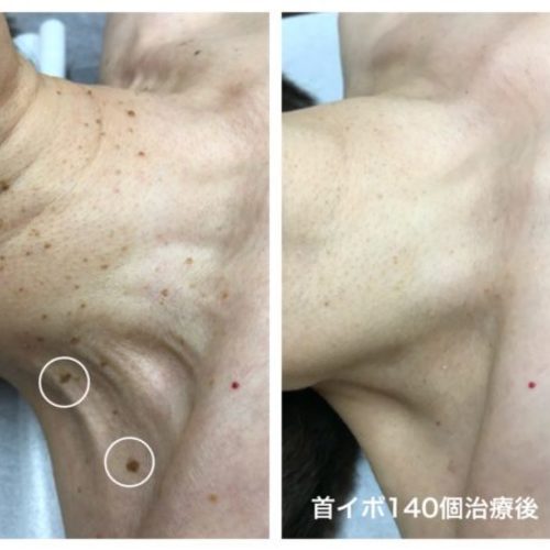 【東京浜松町院】Dr.mikoの首イボ(2度目の受診以降で体のイボも可)