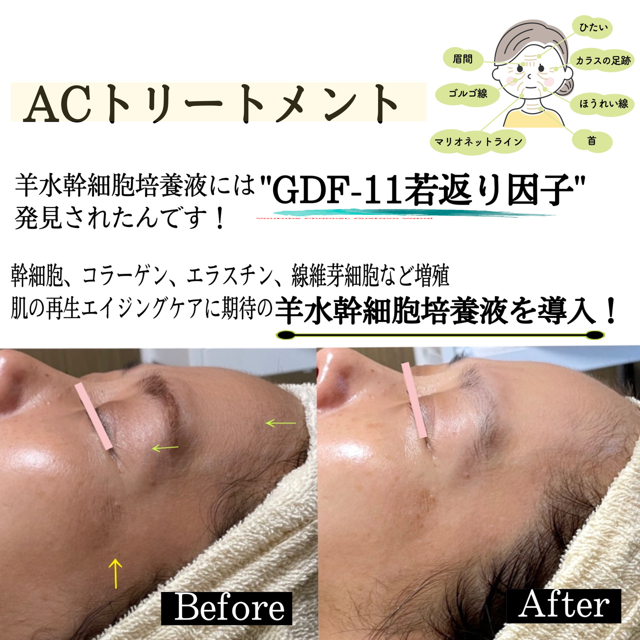 ACトリートメントマシン AC トリートメント プレミアムマシン［リアボーテ］｜inic